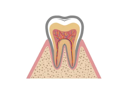 歯垢（プラーク）の蓄積