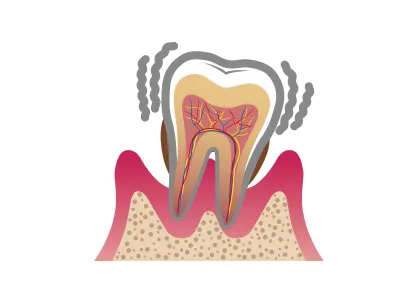 歯の動揺・喪失